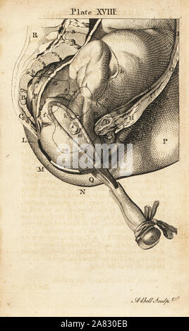 Fetus Kopf brachte unten im Geburtskanal mit Zange. Kupferstich von Andrew Bell nach einer Illustration von Jan van Rymsdyk von William Smellie eine Reihe von anatomischen Tabellen, Charles Elliot, Edinburgh, 1780. Stockfoto