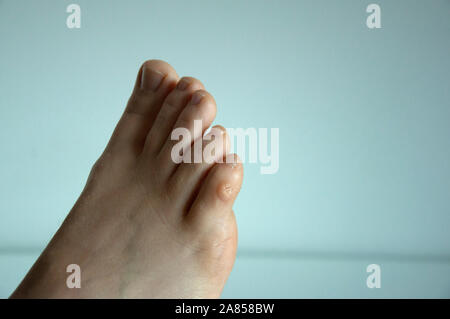 Ein mais Putz auf den kleinen Zehen eines Fußes, auf weißem Hintergrund. Stockfoto