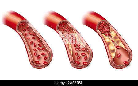 3D-Abbildung: Blut in gesunde Arterie und Anfang Arteriosklerose Stockfoto