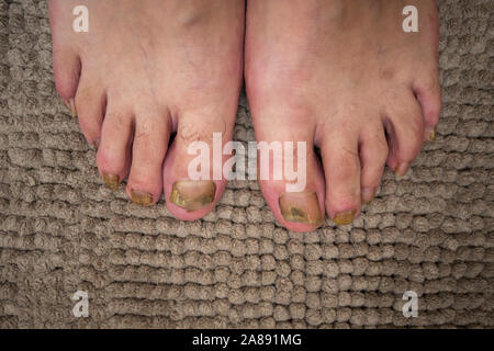 Onychomycosis mit Pilzen nagelinfektion zwei Füße. Stockfoto