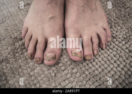 Onychomycosis mit Pilzen nagelinfektion zwei Füße. Stockfoto