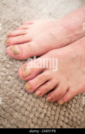 Onychomycosis mit Pilzen nagelinfektion zwei Füße. Stockfoto