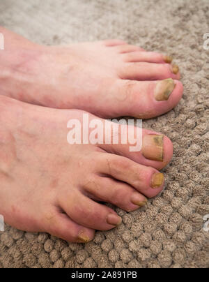 Onychomycosis mit Pilzen nagelinfektion zwei Füße. Stockfoto