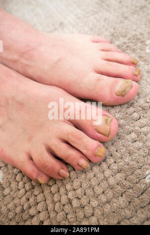 Onychomycosis mit Pilzen nagelinfektion zwei Füße. Stockfoto