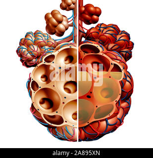 Pneumonie und Lungenbläschen mit Flüssigkeit Diagramm oder alveolus Entzündung Anatomie Diagramm als medizinisches Konzept von gesunden und ungesunden Lunge. Stockfoto