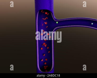 Arterie mit einem abgetrennten Bereichs, hochwertige Rendering mit original Texturen und Global Illumination, Kontraktion der Blutgefäße dargestellt Stockfoto