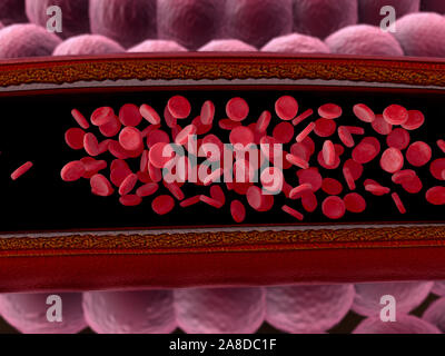 Arterie mit einem abgetrennten Bereichs, hochwertige Rendering mit original Texturen und Global Illumination, Kontraktion der Blutgefäße dargestellt Stockfoto