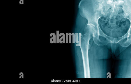 Röntgenbild der Hüfte und degenerative Veränderungen oder avaskuläre Nekrose hip zeigen Stockfoto