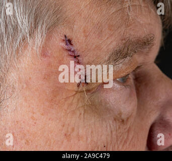 Ältere Erwachsene männliche mit Stichen in den Schnitt nach der Operation zur Entfernung von basalzellkarzinom durch Sonne verursachte Schäden Stockfoto
