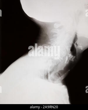 Seite Blick auf ein X-ray von einem menschlichen Kopf, Nacken und Schultern Stockfoto