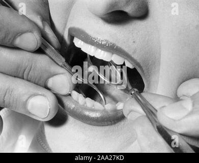 Beim Zahnarzt. Eine Frau wird für Plaque und Zahnstein durch einen Zahnarzt behandelt. 1940s-1950s Stockfoto