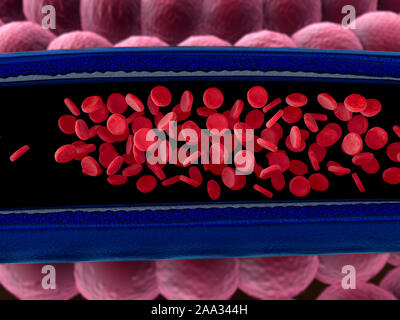 Arterie mit einem abgetrennten Bereichs, hochwertige Rendering mit original Texturen und Global Illumination, Kontraktion der Blutgefäße dargestellt Stockfoto