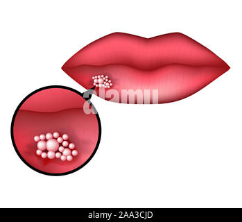 Herpes an der Lippe. Infografiken. Abbildung auf isolierte Hintergrund. Stockfoto