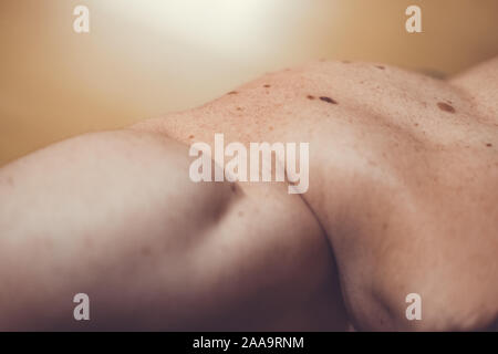Auch ein melanocytic Nevus als nevocytic oder nevus-cell Nevus und allgemein als Maulwurf ist eine Art von Melanocytic Tumors bekannt Stockfoto