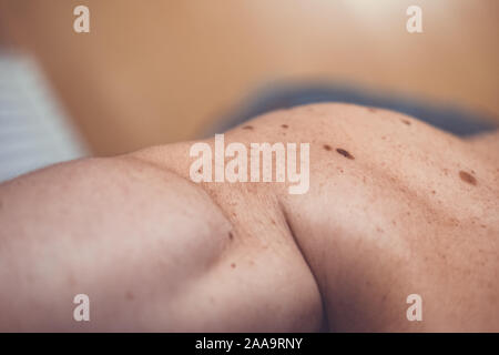 Auch ein melanocytic Nevus als nevocytic oder nevus-cell Nevus und allgemein als Maulwurf ist eine Art von Melanocytic Tumors bekannt Stockfoto