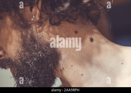 Auch ein melanocytic Nevus als nevocytic oder nevus-cell Nevus und allgemein als Maulwurf ist eine Art von Melanocytic Tumors bekannt Stockfoto