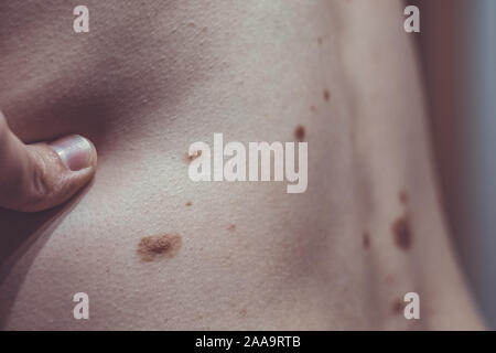 Auch ein melanocytic Nevus als nevocytic oder nevus-cell Nevus und allgemein als Maulwurf ist eine Art von Melanocytic Tumors bekannt Stockfoto