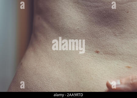 Auch ein melanocytic Nevus als nevocytic oder nevus-cell Nevus und allgemein als Maulwurf ist eine Art von Melanocytic Tumors bekannt Stockfoto