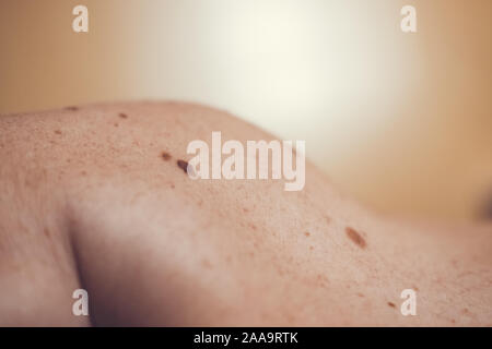 Auch ein melanocytic Nevus als nevocytic oder nevus-cell Nevus und allgemein als Maulwurf ist eine Art von Melanocytic Tumors bekannt Stockfoto