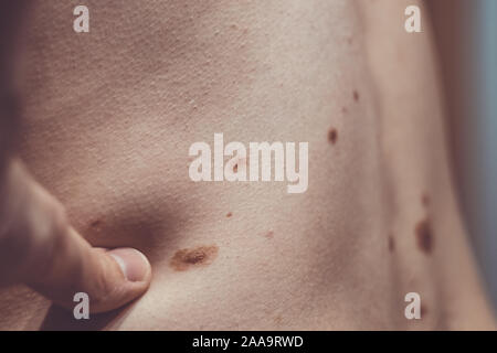 Auch ein melanocytic Nevus als nevocytic oder nevus-cell Nevus und allgemein als Maulwurf ist eine Art von Melanocytic Tumors bekannt Stockfoto