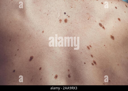 Auch ein melanocytic Nevus als nevocytic oder nevus-cell Nevus und allgemein als Maulwurf ist eine Art von Melanocytic Tumors bekannt Stockfoto
