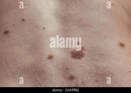 Auch ein melanocytic Nevus als nevocytic oder nevus-cell Nevus und allgemein als Maulwurf ist eine Art von Melanocytic Tumors bekannt Stockfoto
