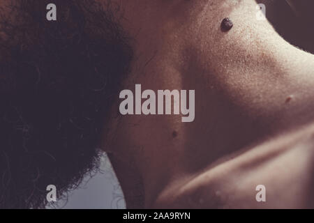 Auch ein melanocytic Nevus als nevocytic oder nevus-cell Nevus und allgemein als Maulwurf ist eine Art von Melanocytic Tumors bekannt Stockfoto