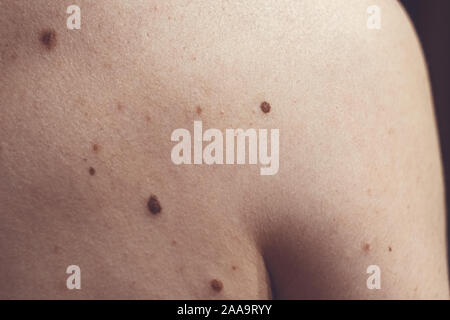Auch ein melanocytic Nevus als nevocytic oder nevus-cell Nevus und allgemein als Maulwurf ist eine Art von Melanocytic Tumors bekannt Stockfoto