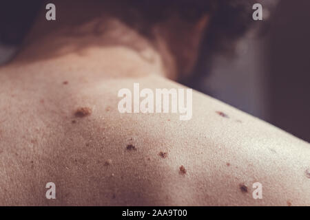 Auch ein melanocytic Nevus als nevocytic oder nevus-cell Nevus und allgemein als Maulwurf ist eine Art von Melanocytic Tumors bekannt Stockfoto