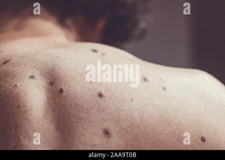 Auch ein melanocytic Nevus als nevocytic oder nevus-cell Nevus und allgemein als Maulwurf ist eine Art von Melanocytic Tumors bekannt Stockfoto