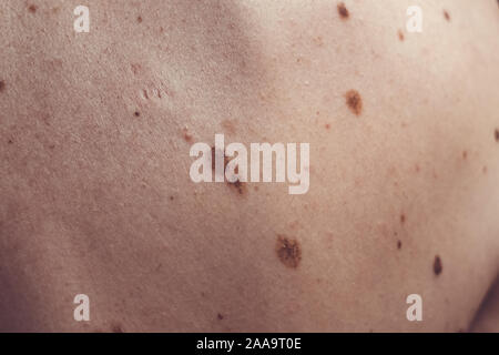 Auch ein melanocytic Nevus als nevocytic oder nevus-cell Nevus und allgemein als Maulwurf ist eine Art von Melanocytic Tumors bekannt Stockfoto