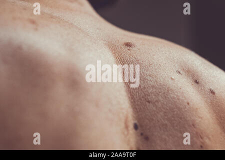 Auch ein melanocytic Nevus als nevocytic oder nevus-cell Nevus und allgemein als Maulwurf ist eine Art von Melanocytic Tumors bekannt Stockfoto
