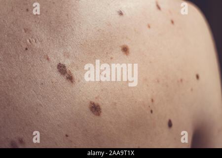 Auch ein melanocytic Nevus als nevocytic oder nevus-cell Nevus und allgemein als Maulwurf ist eine Art von Melanocytic Tumors bekannt Stockfoto