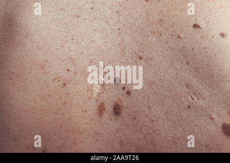 Auch ein melanocytic Nevus als nevocytic oder nevus-cell Nevus und allgemein als Maulwurf ist eine Art von Melanocytic Tumors bekannt Stockfoto