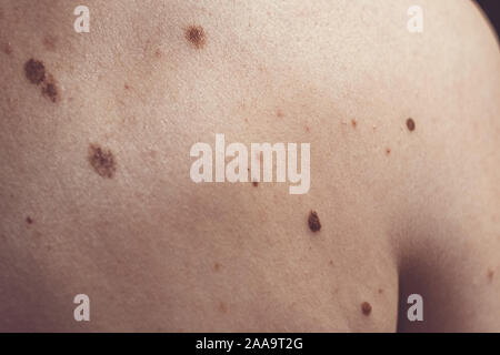 Auch ein melanocytic Nevus als nevocytic oder nevus-cell Nevus und allgemein als Maulwurf ist eine Art von Melanocytic Tumors bekannt Stockfoto