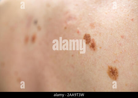 Auch ein melanocytic Nevus als nevocytic oder nevus-cell Nevus und allgemein als Maulwurf ist eine Art von Melanocytic Tumors bekannt Stockfoto