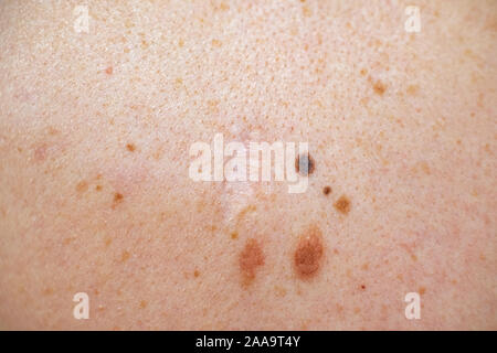 Auch ein melanocytic Nevus als nevocytic oder nevus-cell Nevus und allgemein als Maulwurf ist eine Art von Melanocytic Tumors bekannt Stockfoto