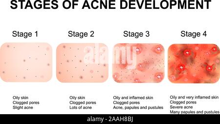 Phasen der Entwicklung der Akne. Entzündeter Haut mit Narben, Akne und Pickel. Die Textur der entzündete Haut, Akne und Pickeln. Infografiken. Vektor Stock Vektor