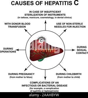 Ursachen von Hepatitis C. Welthepatitis-tages. Infografiken. Vector Illustration auf isolierte Hintergrund. Stock Vektor