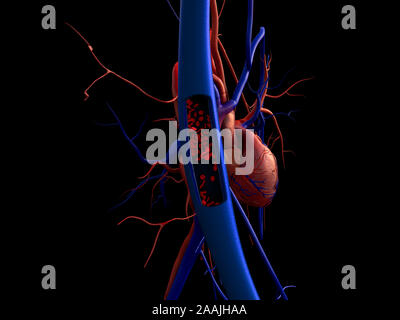 Blutgefäße, Arterien mit einem abgetrennten Bereichs, hochwertige Rendering mit original Texturen und Global Illumination gezeigt, Stockfoto