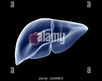 Leber Tumor, computer Abbildung. Stockfoto