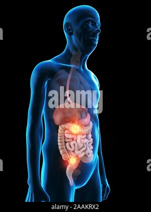 Abbildung: verdauungssystem Tumor eines alten Mannes. Stockfoto