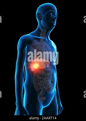 Abbildung: Leber Tumor eines alten Mannes. Stockfoto