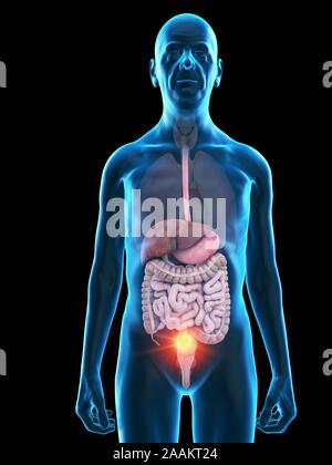 Abbildung der verdauungsfördernden Tumor eines alten Mannes. Stockfoto