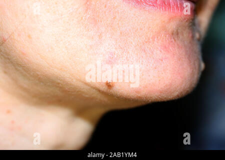 Muttermal auf sein Kinn. Eine Mole auf der Haut in Gesicht. Stockfoto