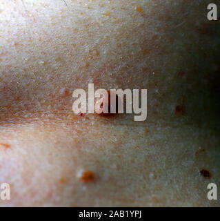 Mole auf der Haut des Körpers. Muttermal. Acrochordon. Stockfoto
