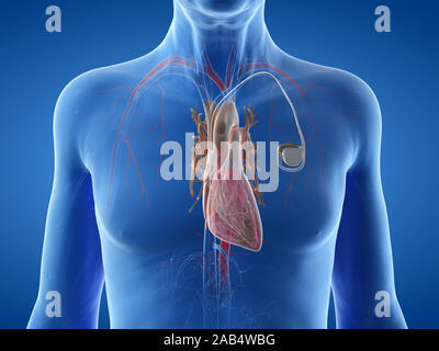 3D-gerenderte Abbildung: Ein alter Mann mit einem Herzschrittmacher Stockfoto