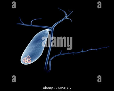 3D-gerenderte Medizinisch genaue Darstellung der Gallenblase Steine Stockfoto