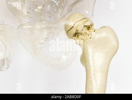 Schwere Arthrose der Hüfte - 3D-Rendering Stockfoto