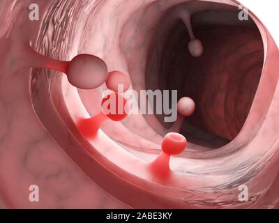 3D-gerenderte Medizinisch genaue Abbildung von dickdarmpolypen Stockfoto